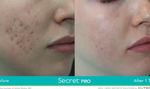 rf laser acne scars reducttion before after mississauga oakville